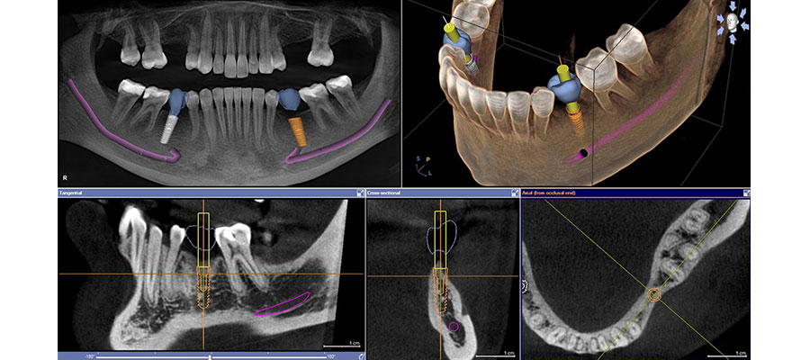 Импланты на КТ челюсти - снимки