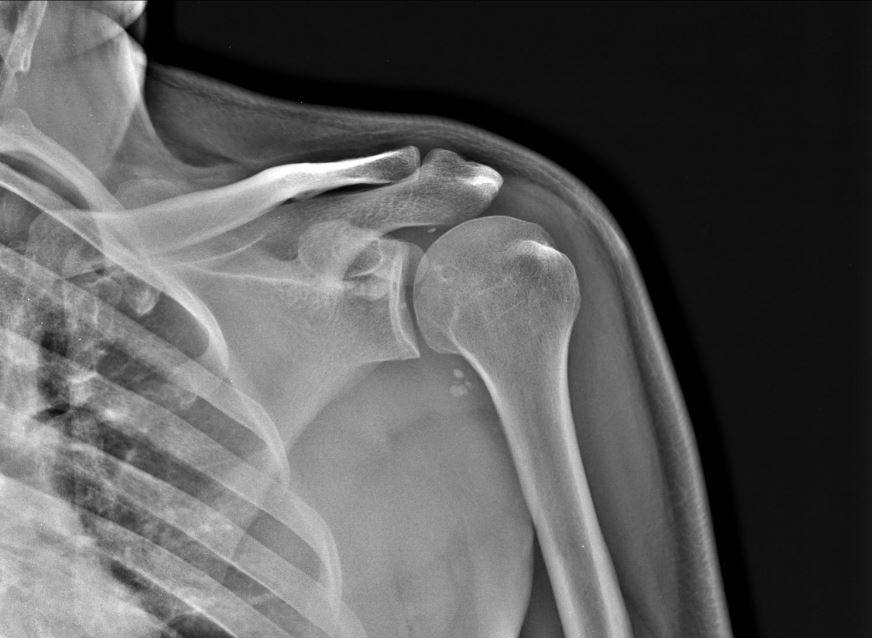 КТ плечевого сустава при переломе