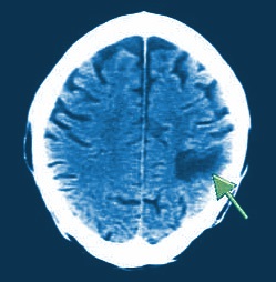 КТ головного мозга при опухолях - эффективность