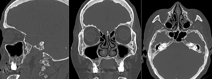 Снимки КТ пазух носа в разных ракурсах