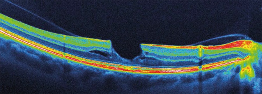 ОКТ сетчатки глаза - изображение на экране