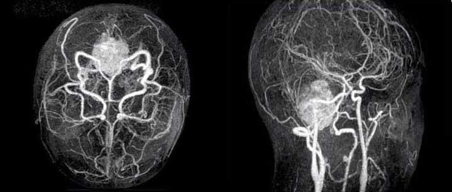 МР-ангиография сосудов головного мозга