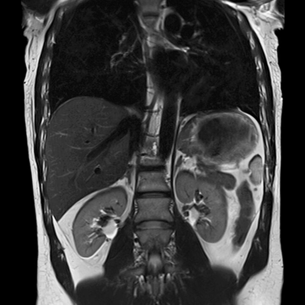 МРТ брюшной полости - что показывают снимки