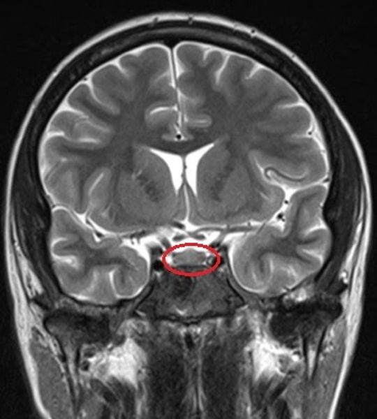 МРТ головного мозга и гипофиза - снимки