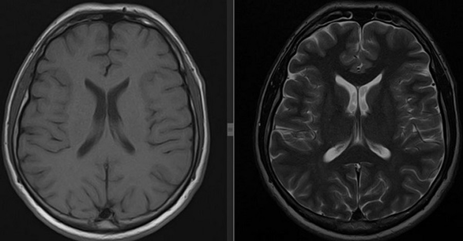 Головной мозг на МРТ в режиме Т1 и Т2