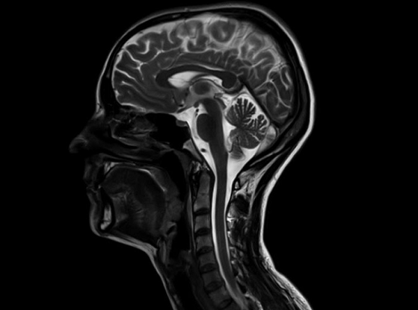 МРТ головного мозга и шейного отдела позвоночника - снимки