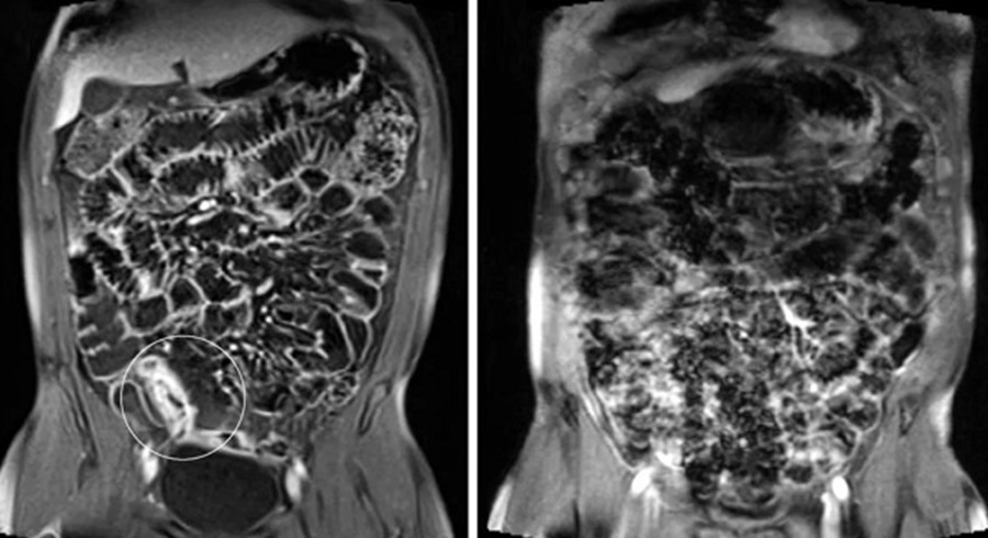 Снимки МРТ кишечника.