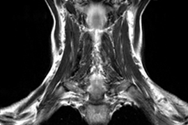 МРТ мягких тканей шеи - снимки