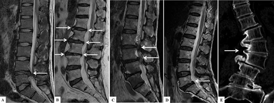 Заболевания позвоночника на МРТ снимках