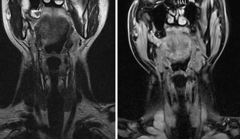 МРТ щитовидной железы с контрастом - снимки