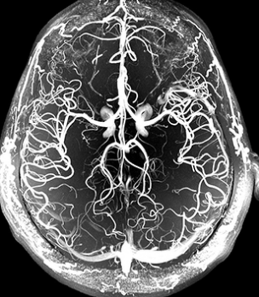 МРТ сосудов головного мозга - артерии и вены