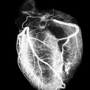 МРТ сердца - снимки при атеросклерозе