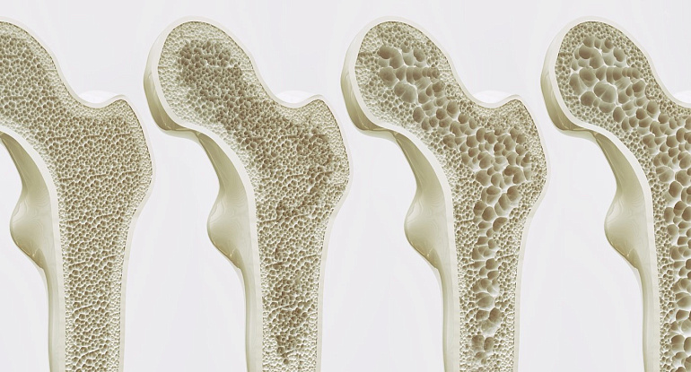 КТ плечевой кости при остеопорозе - что показывает
