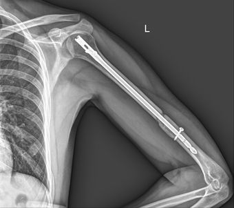 Рентген плечевой кости - снимки