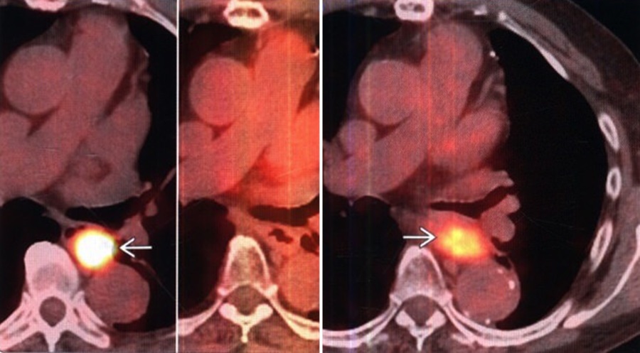 Подсвеченная опухоль на снимках ПЭТ-КТ