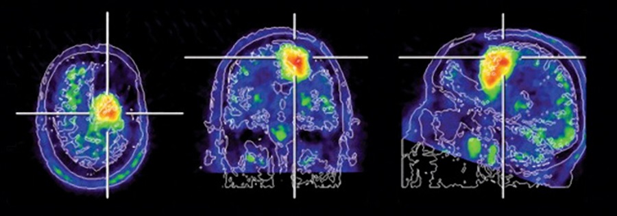 Снимки ПЭТ-КТ головного мозга в разных ракурсах