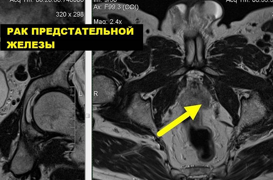 Рак предстательной железы на снимке МРТ