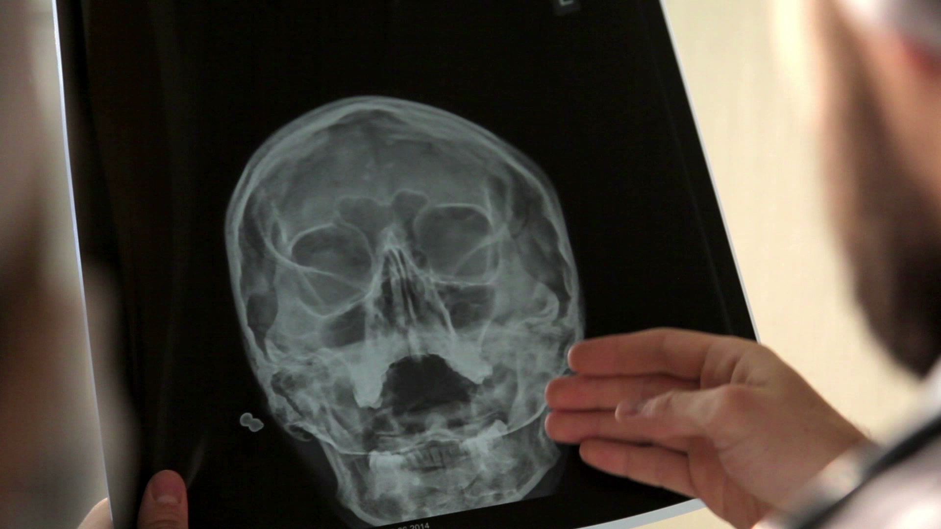 Рентген пазух носа - расшифровка снимков