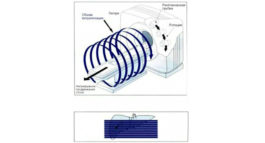 Спиральная компьютерная томография