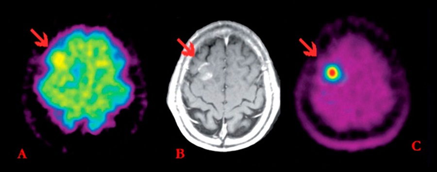ПЭТ-КТ головного мозга - снимки