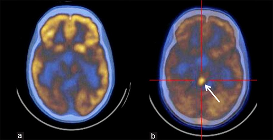 ПЭТ-КТ головного мозга - снимки сверху