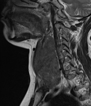 МРТ щитовидной железы при раке - фото