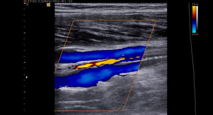Дуплексное УЗИ сосудов - изображение на экране