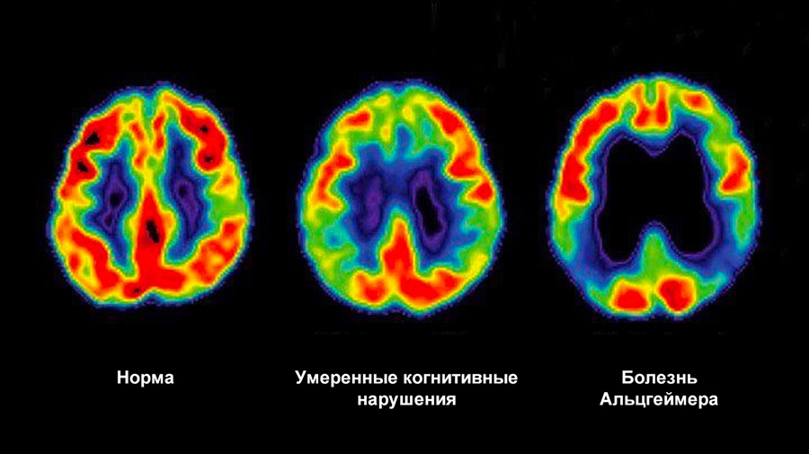 Сравнение нормального мозга и болезни Альцгеймера на снимках ПЭТ-КТ